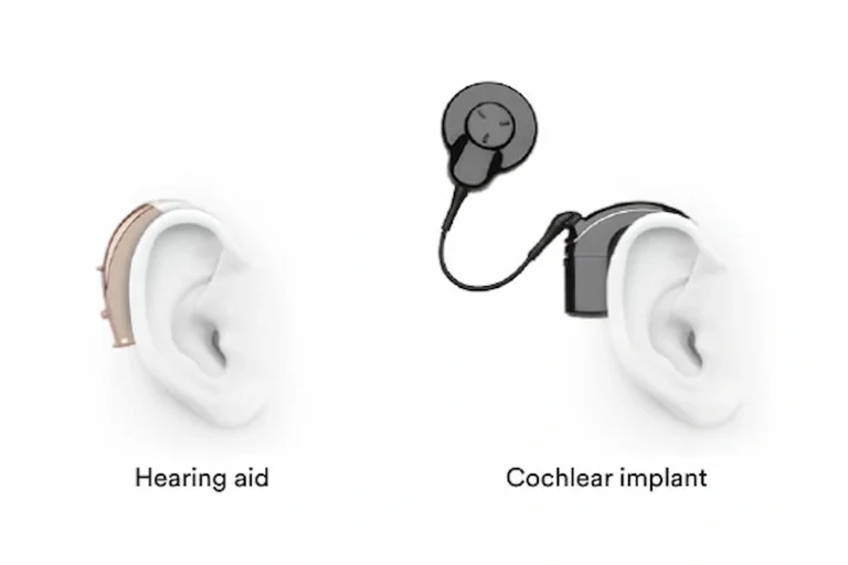 The difference between hearing AIDS and cochlear implants