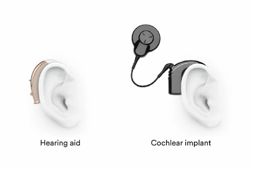 The difference between hearing AIDS and cochlear implants