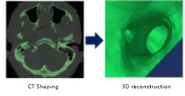 CT scan of the ear canal