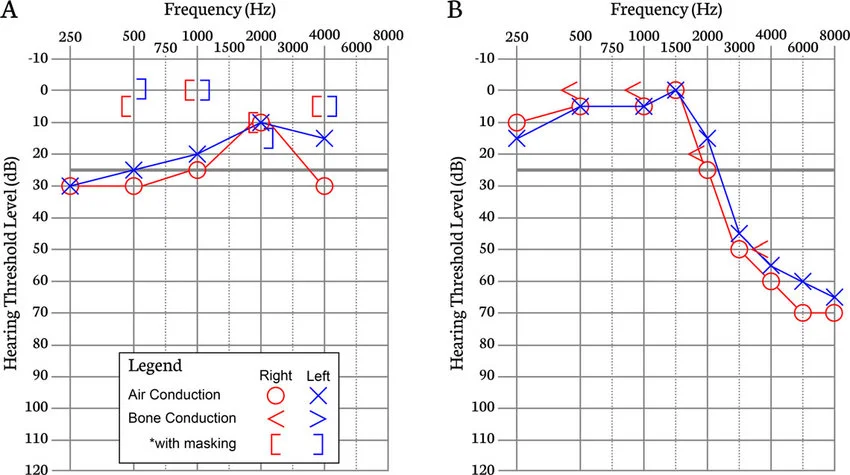 Hearing aid audiogram